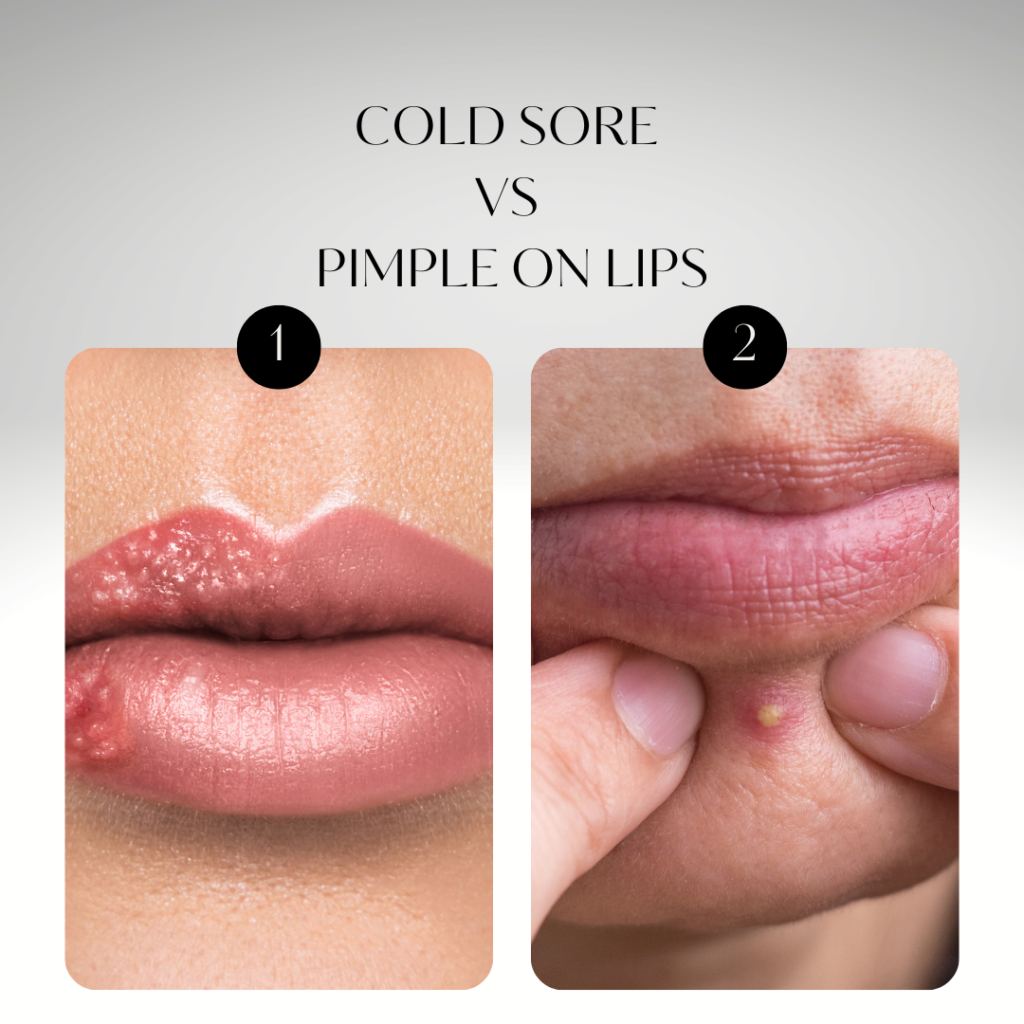 Cold sore vs Pimple on Lips: 4 Absolute Differences and treatment